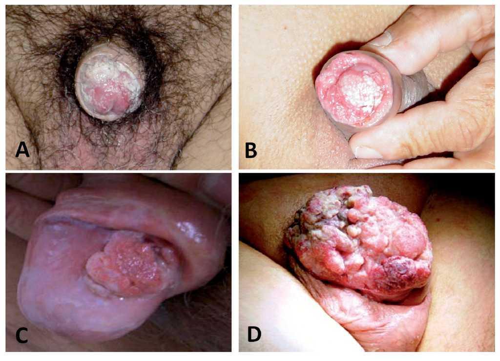 Fig. 5. Lesiones neoplásicas de pene