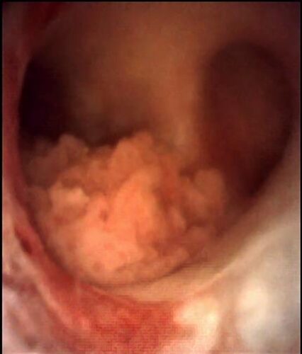 Fig. 3. Imagen endoscópica de CVUA de pelvis renal
