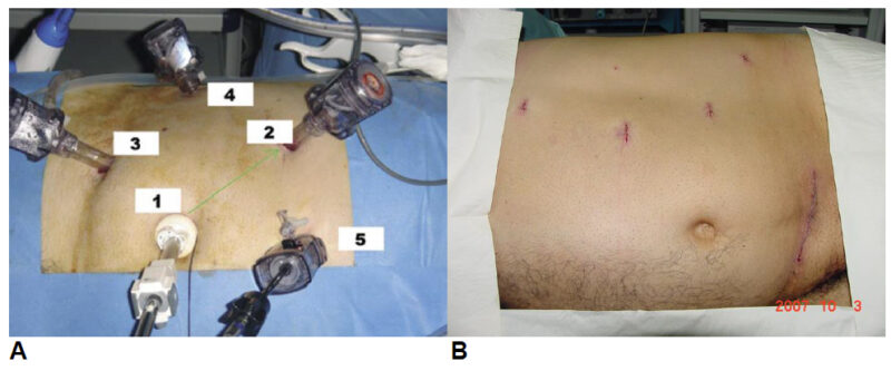 Fig. 6. Ubicación de trócares de NUR laparoscópica A) derecha y B) izquierda