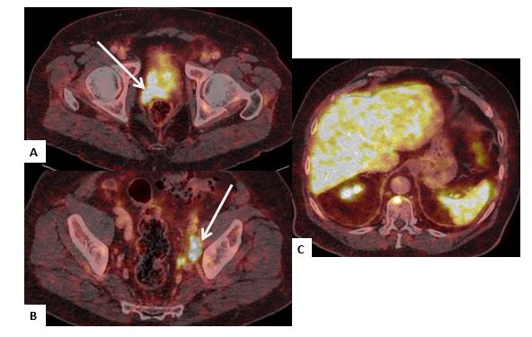 Fig. 7 Etapificación de cáncer de próstata, Gleason 4+5, PSA 15,8 ng/ml. PET/CT-PSMA imágenes fusionadas donde se observa compromiso tumoral extraprostático (flecha en A), adenopatías hipercaptantes iliacas izquierdas (flecha en B) y lesión ósea única en un cuerpo vertebral (flecha en C).