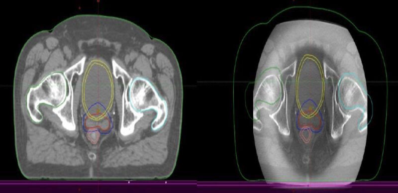 Fig. 3. Técnica de Radioterapia IGRT (Guiada por imágenes). Derecha: TAC de simulación con contornos: Rojo CTV: clinic target volume(próstata y vesículas seminales); Azul: PTV: patologic target volume); Amarillo: Vejiga (OAR); Rosado: Recto (OAR); Verde: Cadera derecha (OAR); Celeste: Cadera izquierda (OAR). Izquierda: Conbeam en máquina de tratamiento, en donde la imagen en el aceleradorse superpone con los contornos hecho en el TAC de simulación.