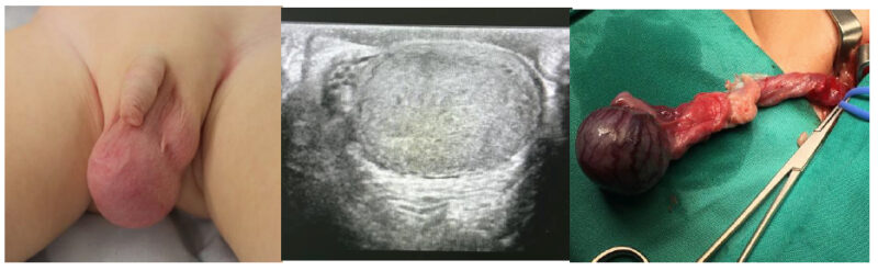 Fig. 13. Paciente portador de un tumor testicular derecho tipo seno endodérmico