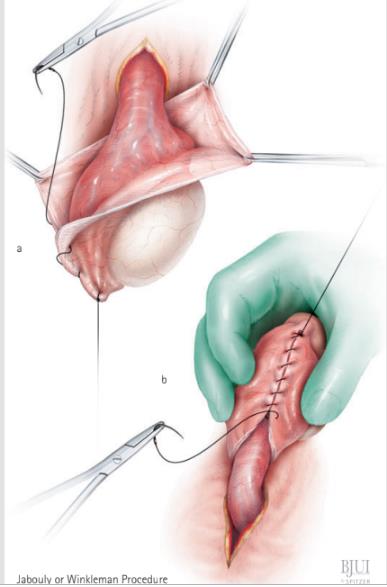 Fig. 8. Eversión de túnica vaginal y cierre hemostático de ambos extremos de la túnica vaginal