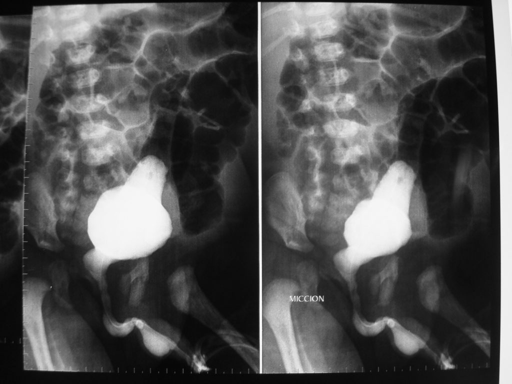 Fig. 7. Uretrocistografía miccional en paciente portador de síndrome de Prune Belly