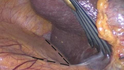 Fig. 17. Incisión peritoneal en “7” para abordaje suprarrenal derecho.