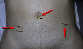 Fig. 32. Sitios de inserción de trocares con sutura intradérmica en varicocele