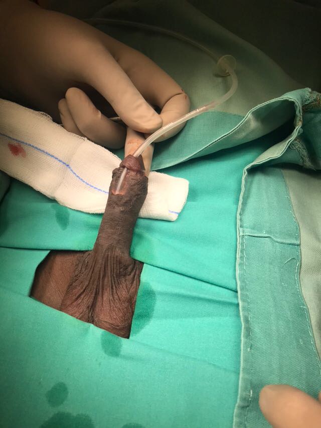 Fig 3. Fistula uretero cutánea post operatoria