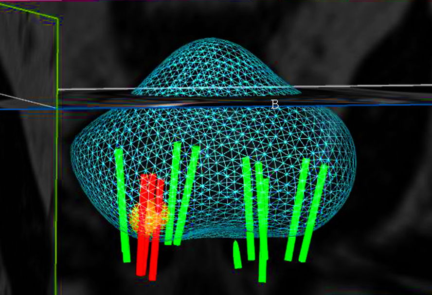 Fig. 3. Reconstrucción 3D biopsia por fusión, con cilindros negativos para cáncer(verdes), positivos (rojos) y área sospecha marcada en resonancia (amarillo).