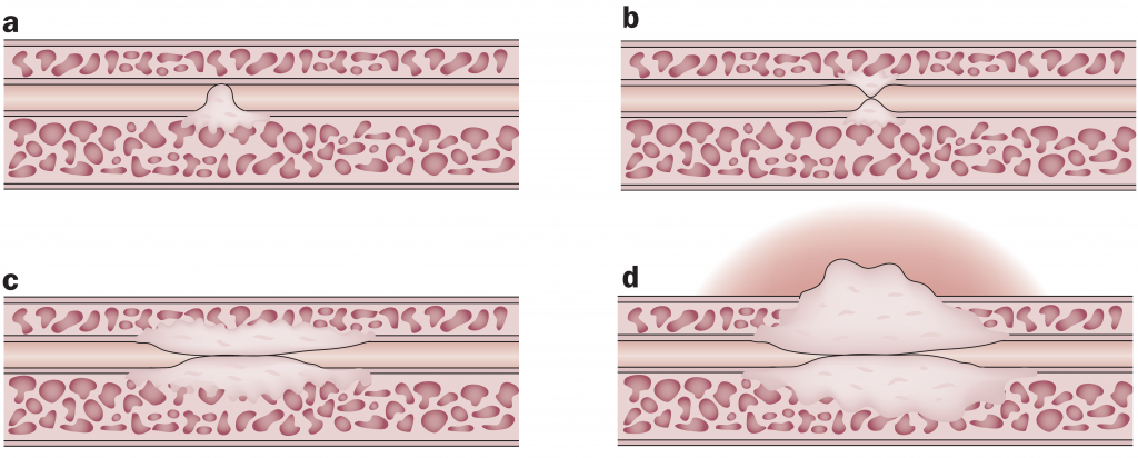 Fig. 3. Fisiopatología de la estrechez. Metaplasia escamosa, b) Disminución del lumen, c y d) Progresión de la espongiofibrosis (Tomado de Hampson et al, 2014)8
