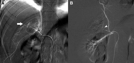 Fig 8. Angiografía en el trauma de la glándula suprarrenal. (A) la arteria suprarrenal derecha inferior reveló extravasación y torsión del territorio vascular (flecha). (B) post-embolización con microcoils y spongostan (punta de flecha); no se observó extravasación ulterior.