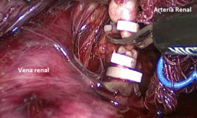 Fig. 21. Control del hilio renal con Hem-o-lockR