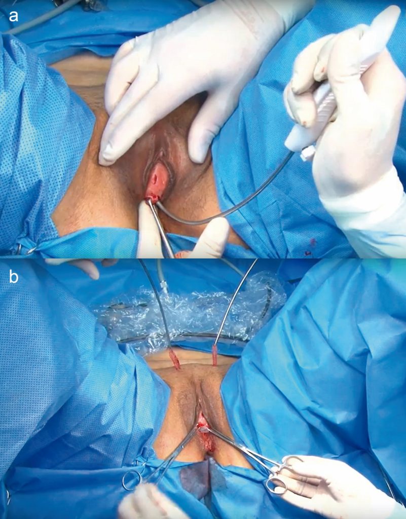 Fig. 4. Cirugía de cinta sub uretral retropúbica. a) Paso de la aguja desde la incisión vaginal hacia la zona suprapúbica al lado derecho de la paciente. b) Trayectoria final de la malla antes de ajustar la tensión y recortar los excedentes.