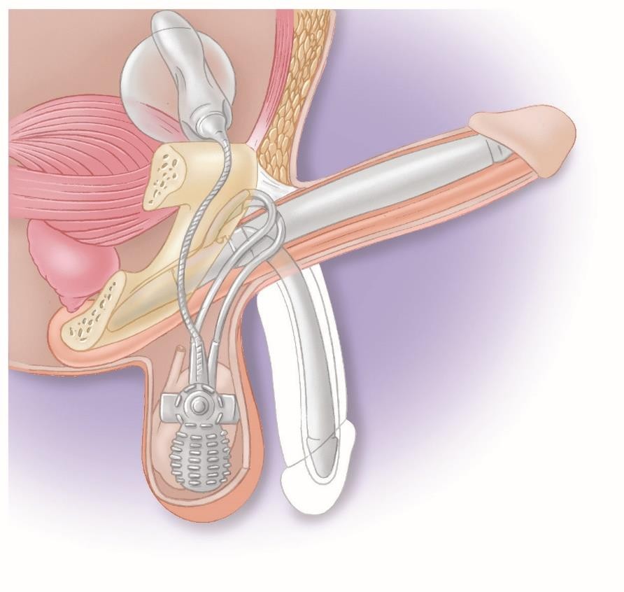 Anillo para mantener la erección Kit 3 tamaños - TMA MÉDICA