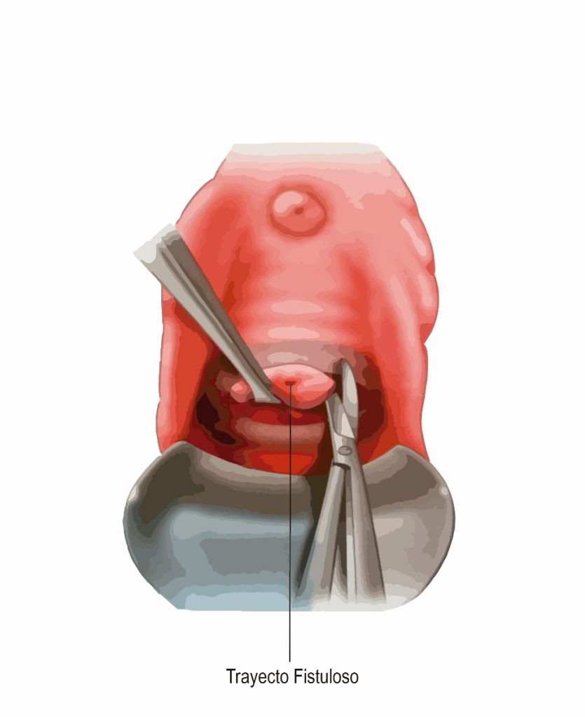 Fig. 22. Disección y resección del ostium vaginal de una FVV durante la cirugía.