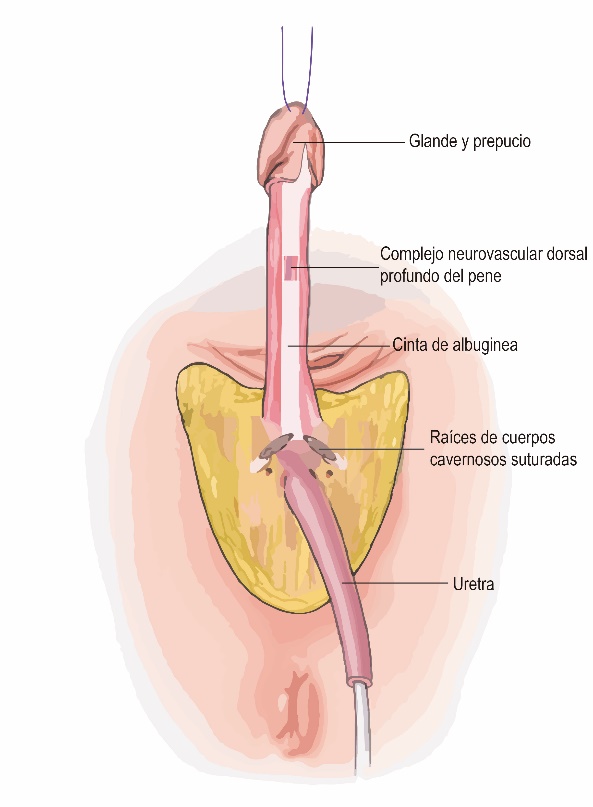 Fig. 1: Pene separado en sus distintos elementos con reseccion de los cuerpos cavernosos y sutura de sus cruras y preservacion de la bandeleta neurovascular dorsal profunda del pene sobre una cinta de albuginea.