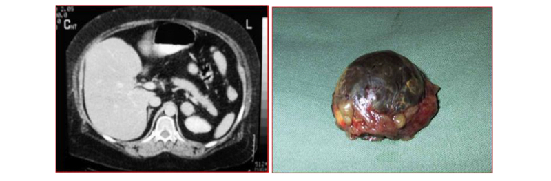 Fig. 16. Incidentaloma de 3 cm, reemplaza completamente la glándula adrenal.