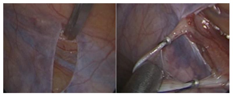 Fig. 33. Técnica de varicocelectomia laparoscópica